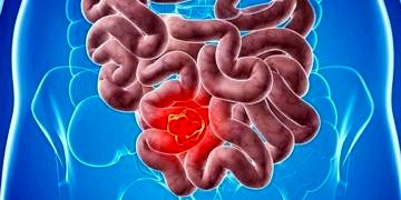 Kalın bağırsak kanserine yol açan 7 önemli etken ve korunma yöntemleri!