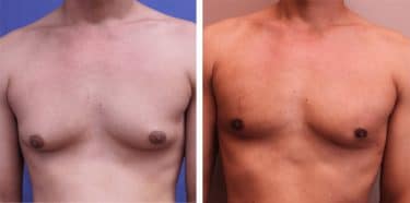 Jinekomasti, erkeklerde meme büyümesi