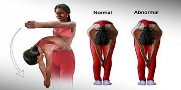 Çocuğunuzda skolyoz olduğunu nasıl anlarsınız? En önemli belirtileri ve tedavisi