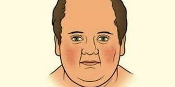 Aniden oluşan ‘ay dede’ yüzüne dikkat! Nedeni Cushing hastalığı olabilir!