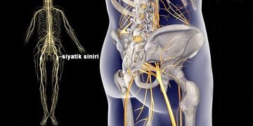 Siyatik nedir? Kimlerde görülür? Siyatiğin nedenleri ve belirtileri