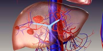 Karaciğer kanseri hepatosellüler karsinom tedavisinde yeni tedavi seçeneği