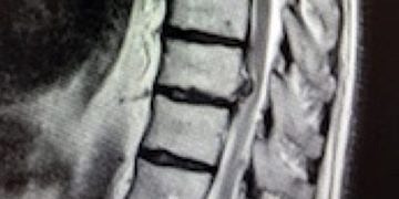 Sırt fıtığı hastalığı (torakal disk hernisi) nedir? Gizli felç eden tehlike