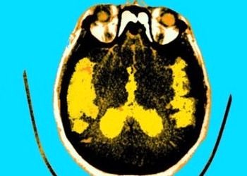 Alzheimer diyabetin bir türevi mi? Bazı uzmanlar Tip 3 diyabet diyor