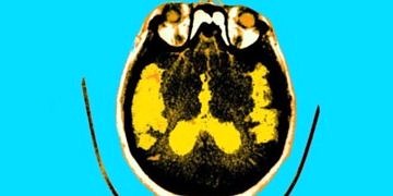 Alzheimer diyabetin bir türevi mi? Bazı uzmanlar Tip 3 diyabet diyor