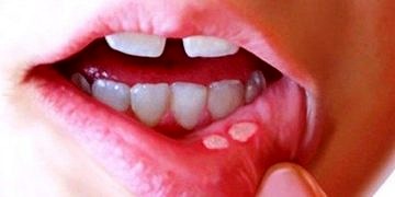 Ağız ülserinin belirtileri ve tedavisi