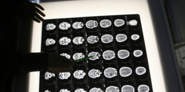 Beynimizin “pasını atarak” Alzheimer olmaktan kurtulabilir miyiz?