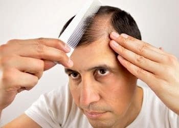 Erkeklerde saç dökülmesi