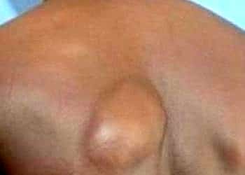 Hızlı büyüyen yağ bezelerine dikkat!