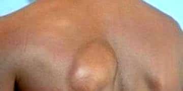 Hızlı büyüyen yağ bezelerine dikkat!