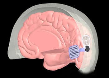 Milyonlarca görme engelli için yeni umut: Biyonik göz-beyin implant’ı