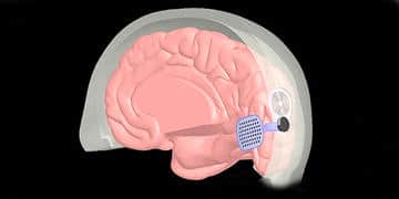 Milyonlarca görme engelli için yeni umut: Biyonik göz-beyin implant’ı