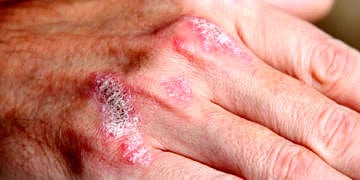 Prof. Gürer: Sedef hastalığında ‘alternatif tedavi’ vaatlerine itibar etmeyin!