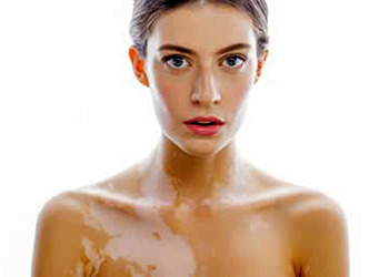Vitiligo (ala hastalığı) nedir? Nedenleri, belirtileri ve tedavisi
