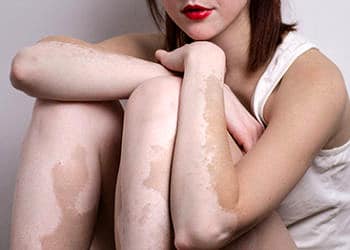 Vitiligo (ala hastalığı) nedir? Nedenleri, belirtileri ve tedavisi
