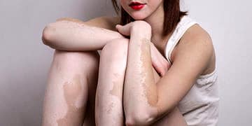 Vitiligo (ala hastalığı) nedir? Nedenleri, belirtileri ve tedavisi