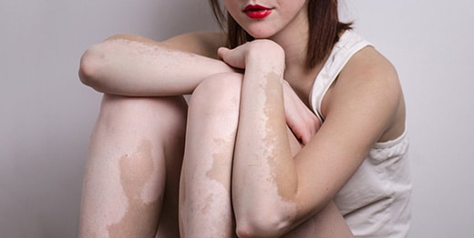 vitiligo ala hastaligi nedir nedenleri belirtileri ve tedavisi