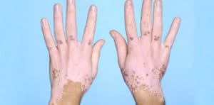 Vitiligo (ala hastalığı) 