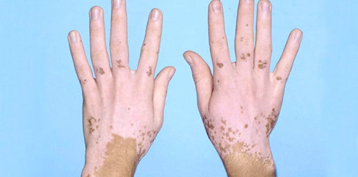 vitiligo ala hastaligi nedir nedenleri belirtileri ve tedavisi