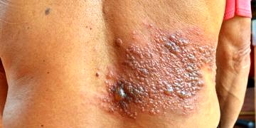 Uykuya yatan virüsler uyanırsa; Zona