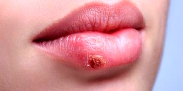 Zayıflayan bağışıklık sisteminin 5 erken sinyali!