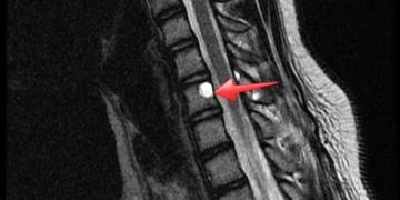 Omurga tümörlerinde uygulanan cerrahi tedavi teknikleri