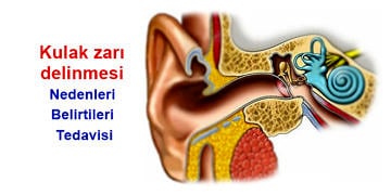 Kulak zarı delinmesi neden olur? Zar yırtılmasının belirtileri ve tedavisi
