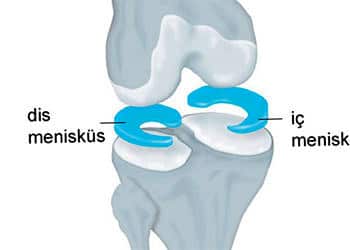 Menisküs nedir, neden yırtılır? Belirtileri ve tedavi yöntemleri