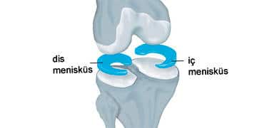 Menisküs nedir, neden yırtılır? Belirtileri ve tedavi yöntemleri