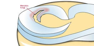 Menisküs yırtılması