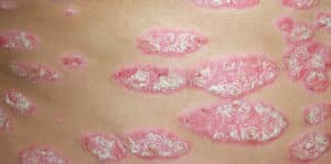 Sedef Hastalığı Belirtileri