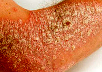 Sedef hastalığı (psoriasis) nedir? Belirtileri, nedenleri ve tedavisi