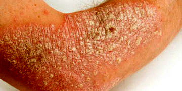 Sedef hastalığı (psoriasis) nedir? Belirtileri, nedenleri ve tedavisi