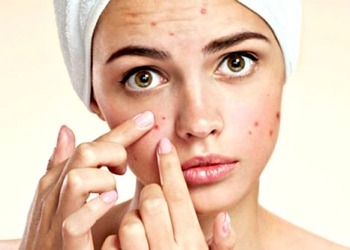 Sivilce neden olur? Sivilceye iyi gelen şifalı bitkiler ve tedaviler