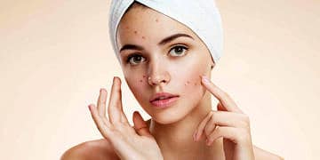 Sivilce neden olur? Sivilceye iyi gelen şifalı bitkiler ve tedaviler