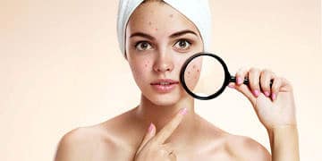 Sivilce neden olur? Sivilceye iyi gelen şifalı bitkiler ve tedaviler