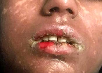 Sınav stresi için gittiği Psikiyatristin verdiği ilacın yan etkisi bu hale getirdi