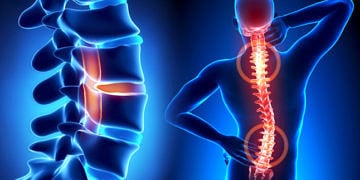 Bel fıtığı neden olur? Belirtileri, tedavi seçenekleri ve ameliyatı