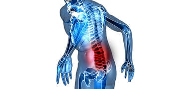 Bel fıtığı neden olur? Belirtileri, tedavi seçenekleri ve ameliyatı