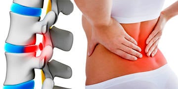 Bel fıtığı neden olur? Belirtileri, tedavi seçenekleri ve ameliyatı