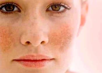 “Gebelik Maskesi” hamilelerin yüzde 75’inde görülüyor