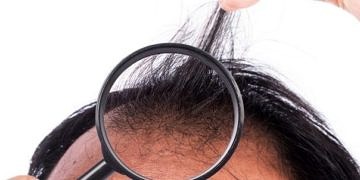 Saç dökülmesi bu hastalıkların işareti olabilir