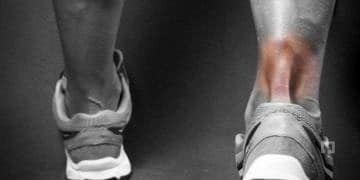 Aşil tendinitinin belirtileri ve tedavisi