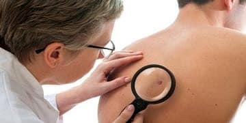 Kanser riski taşıyan benlerdeki 7 önemli belirtiye dikkat edin