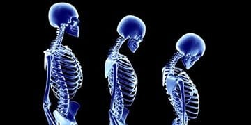 Çocuklardaki postür bozukluğunun 4 sebebi