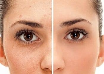 Gözaltı torbalarınızla vedalaşmanın ipuçları…