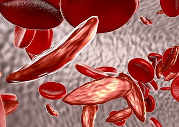 Akdeniz anemisi (talasemi) nedir? Nedenleri, belirtileri ve tedavisi