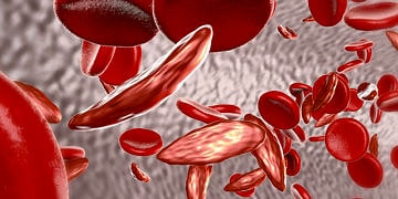 Akdeniz anemisi (talasemi) nedir? Nedenleri, belirtileri ve tedavisi