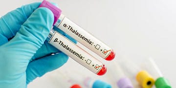 Akdeniz anemisi (talasemi) nedir? Nedenleri, belirtileri ve tedavisi