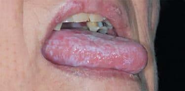 Ağızda oluşan Liken Planus